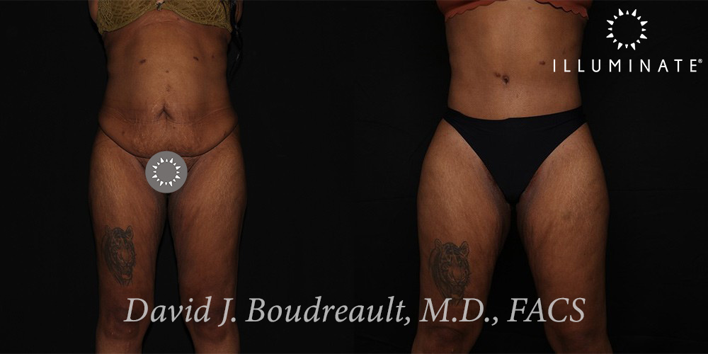 Tummy Tuck Before & After Image