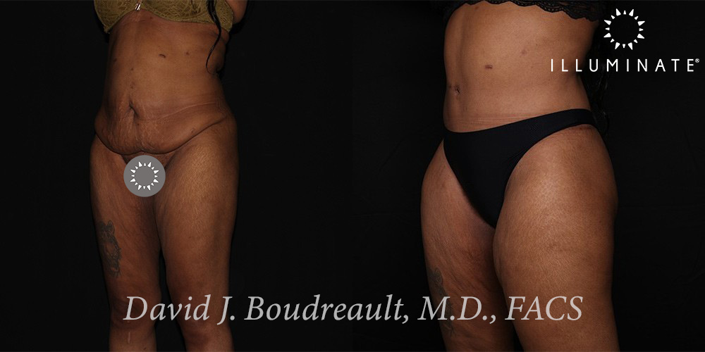 Tummy Tuck Before & After Image