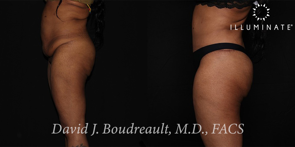Tummy Tuck Before & After Image
