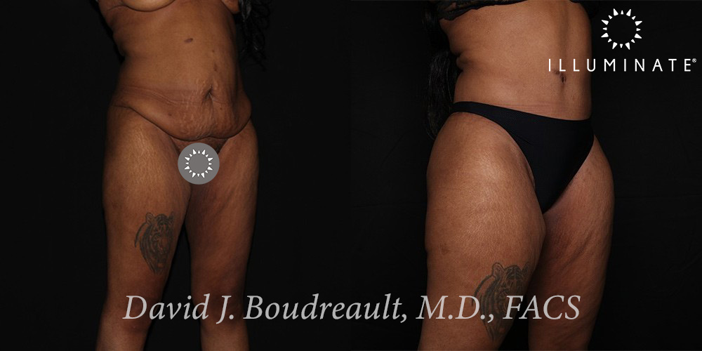 Tummy Tuck Before & After Image