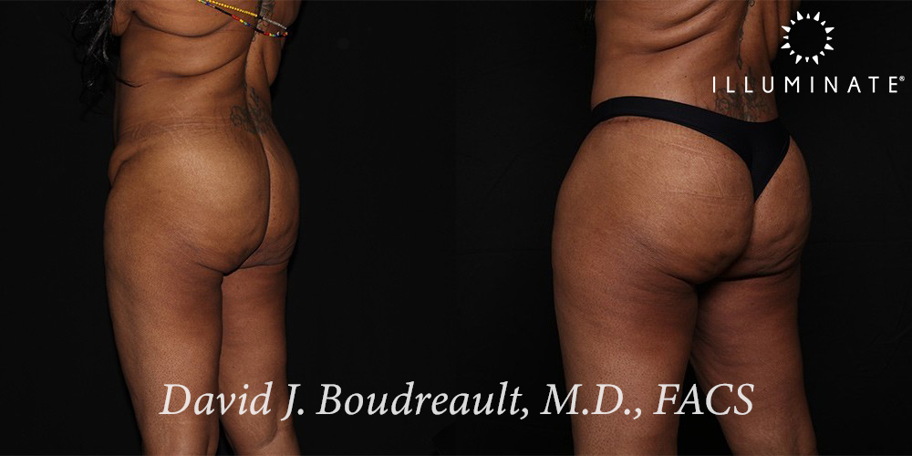 Tummy Tuck Before & After Image