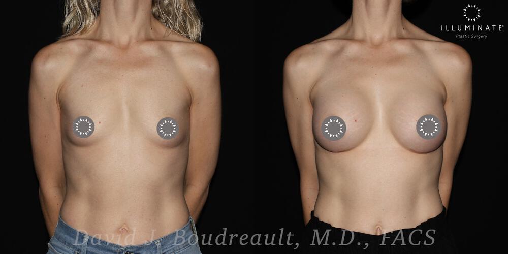 Breast Augmentation Before & After Image