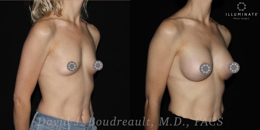 Breast Augmentation Before & After Image