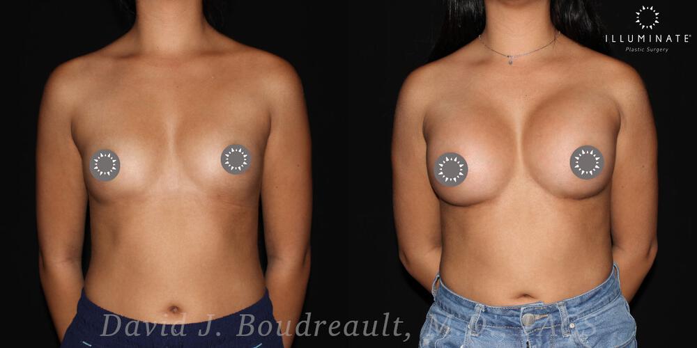 Breast Augmentation Before & After Image