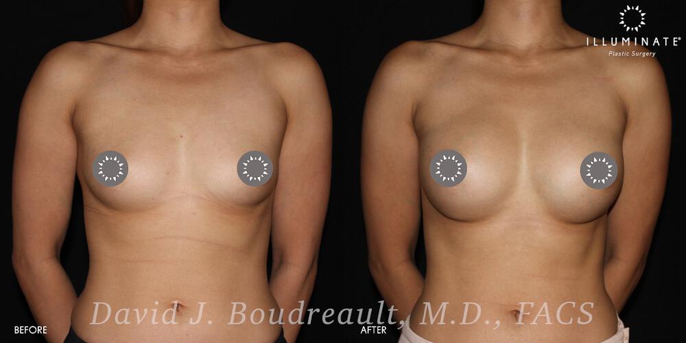 Breast Augmentation Before & After Image