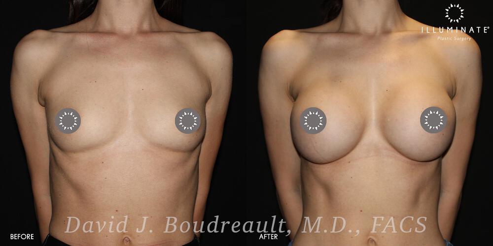 Breast Augmentation Before & After Image