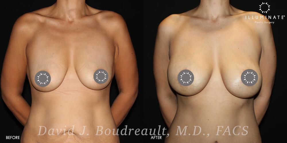 Breast Augmentation Before & After Image