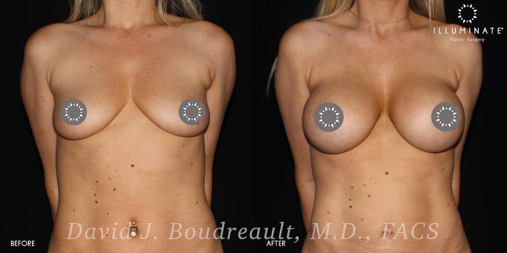 Breast Augmentation Before & After Image