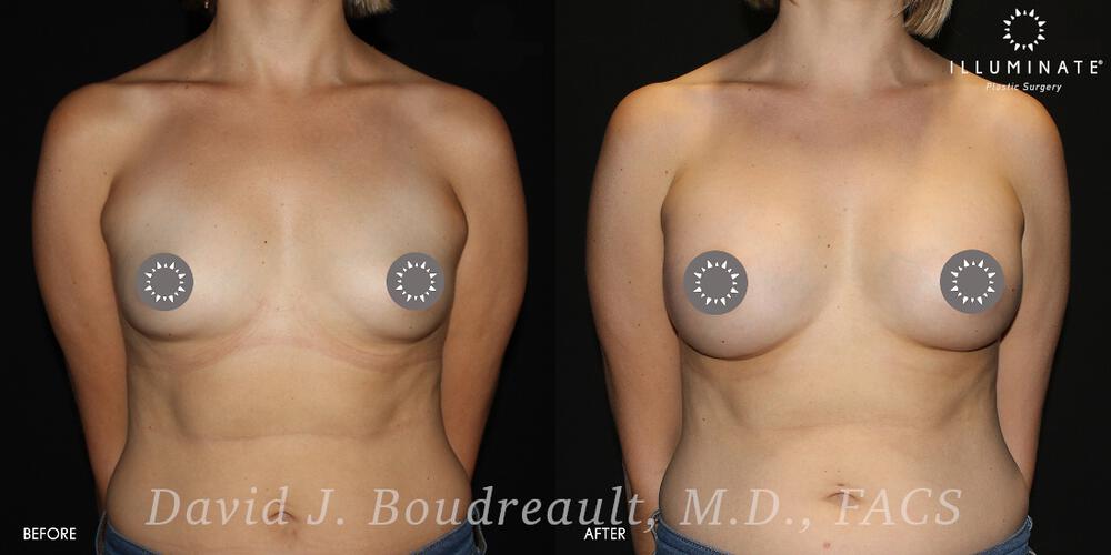 Breast Augmentation Before & After Image