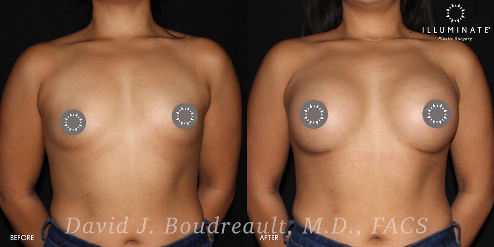 Breast Augmentation Before & After Image