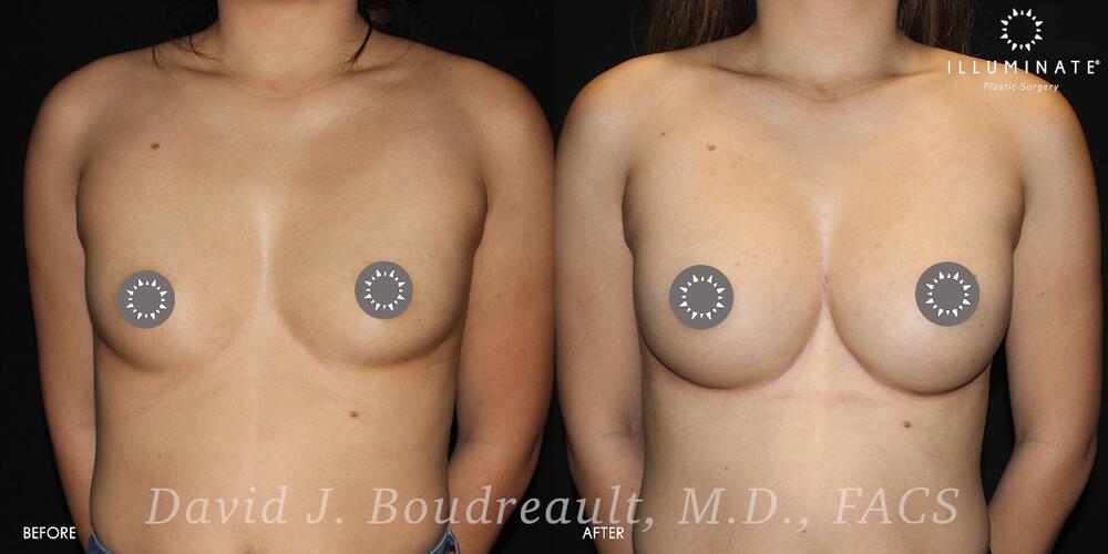 Breast Augmentation Before & After Image