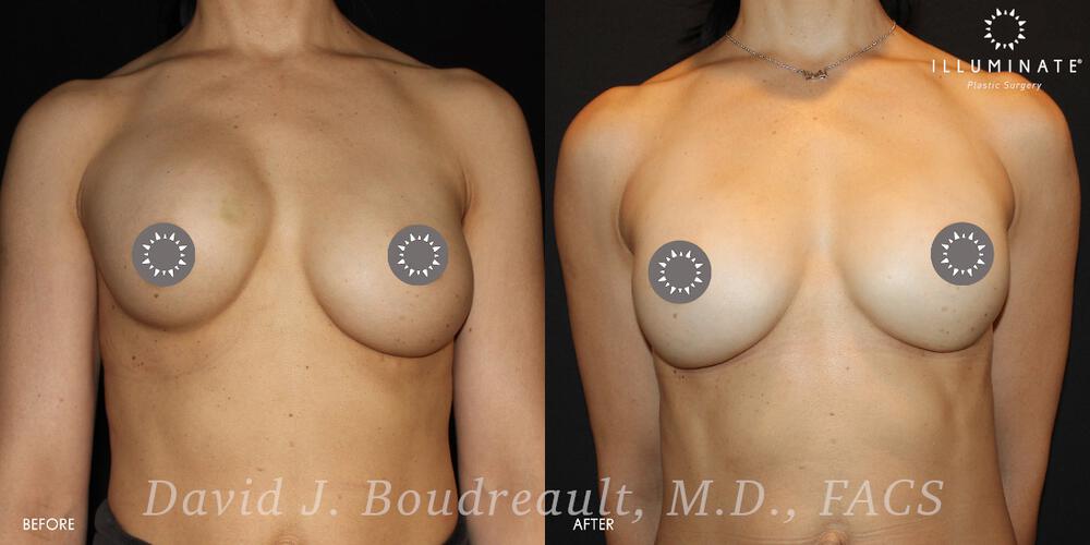 Breast Augmentation Before & After Image