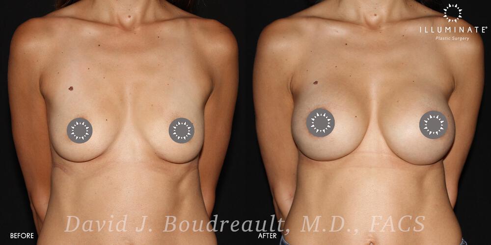 Breast Augmentation Before & After Image