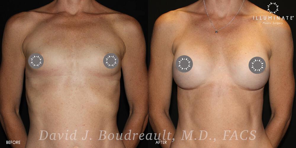 Breast Augmentation Before & After Image