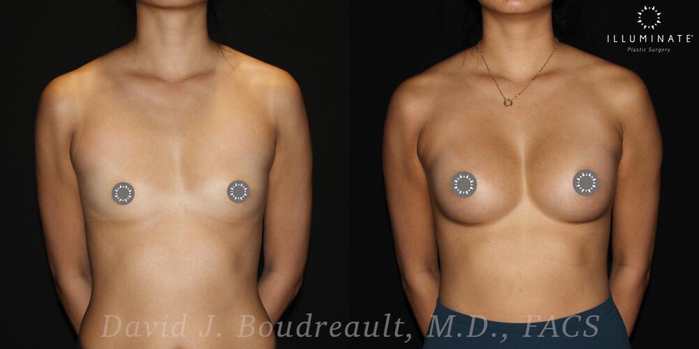 Breast Augmentation Before & After Image