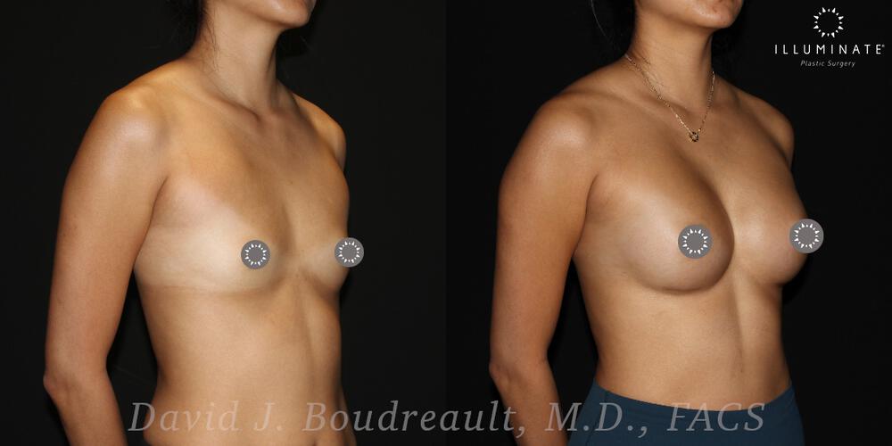 Breast Augmentation Before & After Image