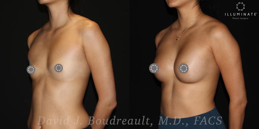 Breast Augmentation Before & After Image