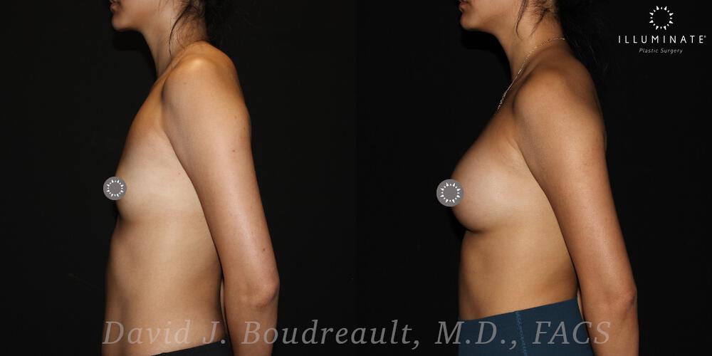 Breast Augmentation Before & After Image