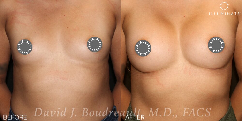 Breast Augmentation Before & After Image