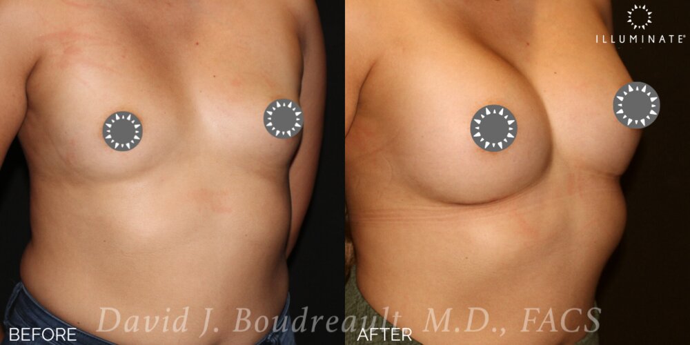 Breast Augmentation Before & After Image