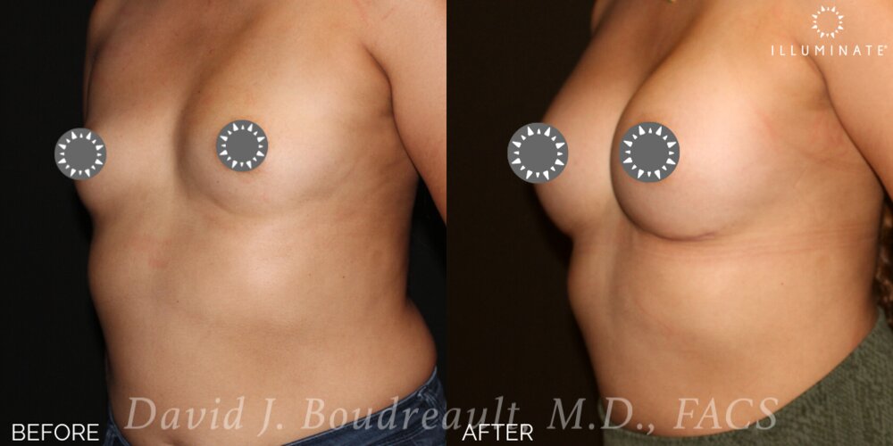 Breast Augmentation Before & After Image