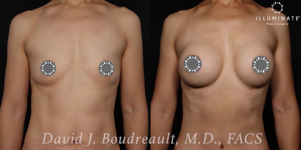 Breast Augmentation Before & After Image