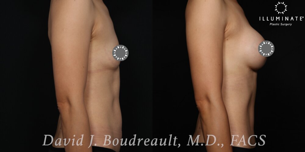 Breast Augmentation Before & After Image