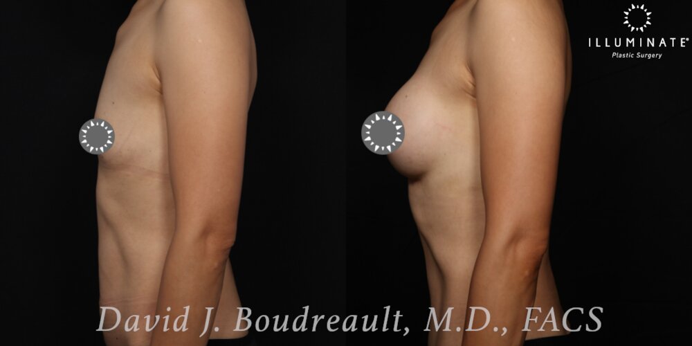 Breast Augmentation Before & After Image