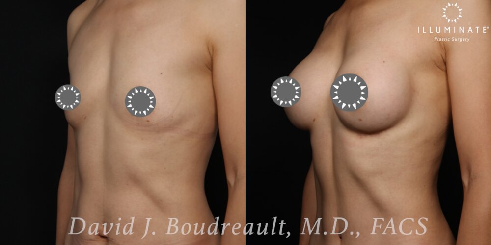 Breast Augmentation Before & After Image