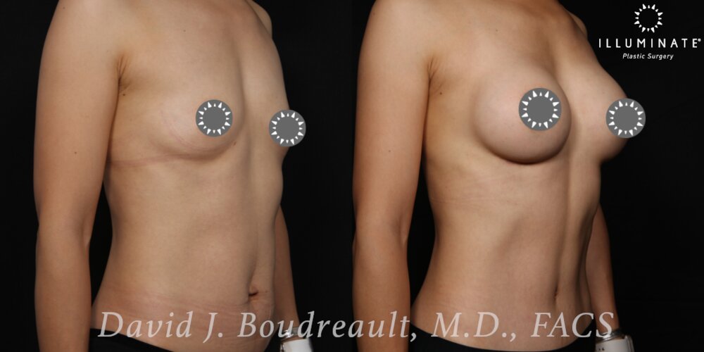 Breast Augmentation Before & After Image