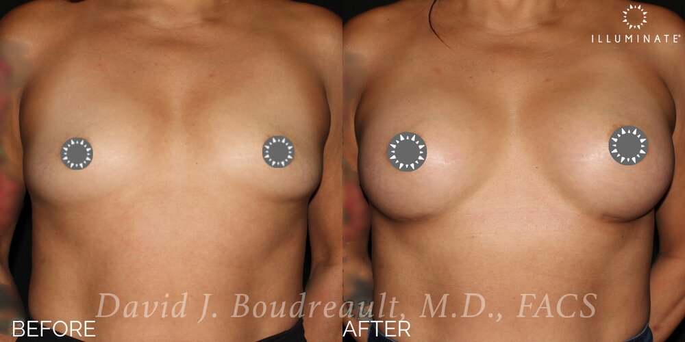 Breast Augmentation Before & After Image