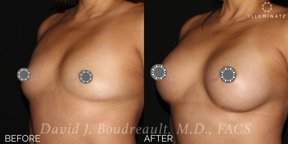 Breast Augmentation Before & After Image