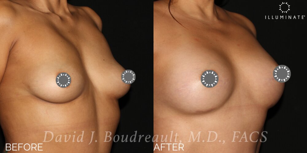 Breast Augmentation Before & After Image