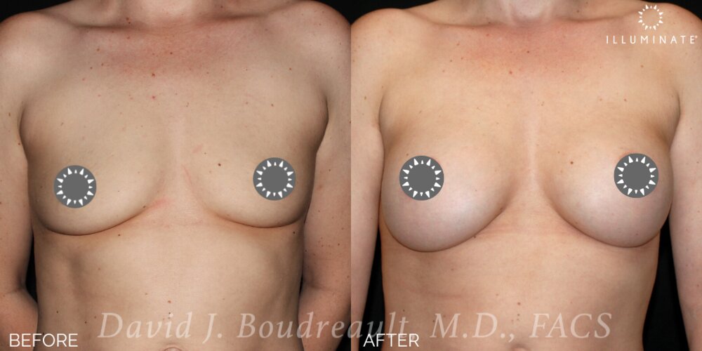 Breast Augmentation Before & After Image