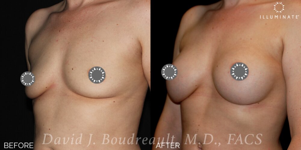 Breast Augmentation Before & After Image