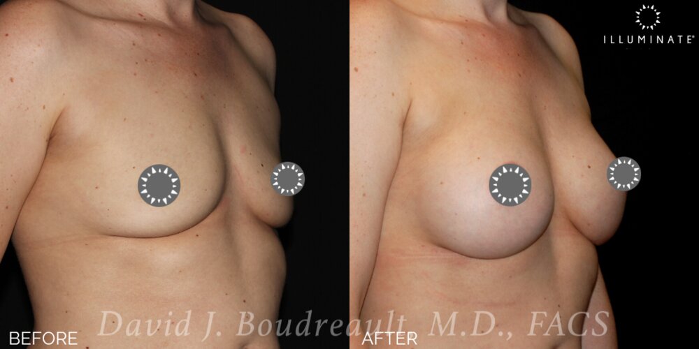 Breast Augmentation Before & After Image