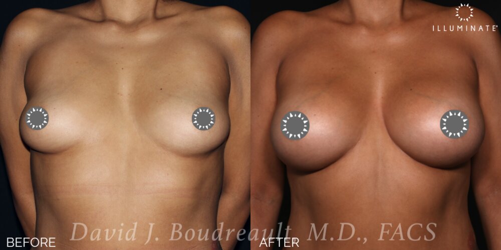 Breast Augmentation Before & After Image