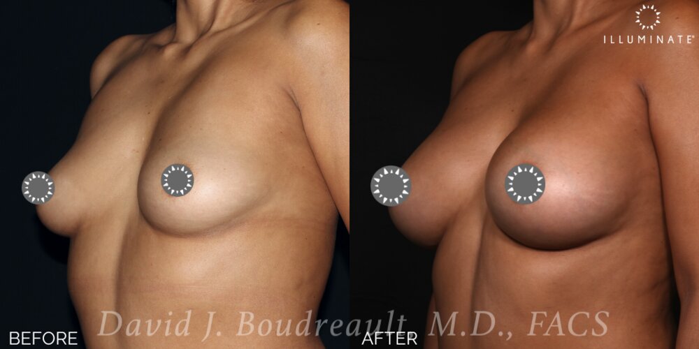 Breast Augmentation Before & After Image