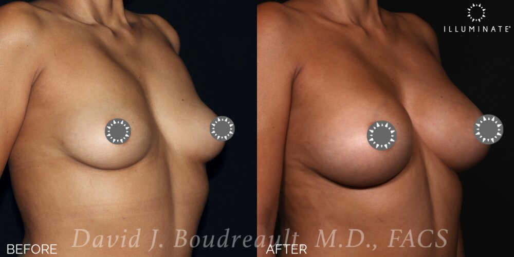 Breast Augmentation Before & After Image