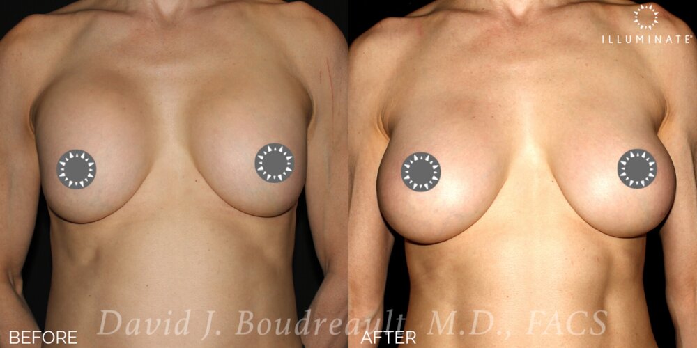 Breast Augmentation Before & After Image