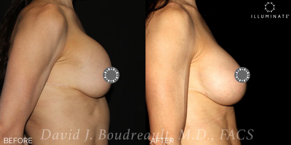 Breast Augmentation Before & After Image