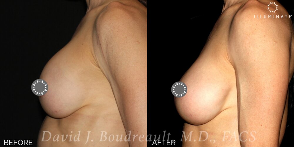 Breast Augmentation Before & After Image