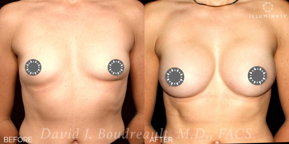 Breast Augmentation Before & After Image