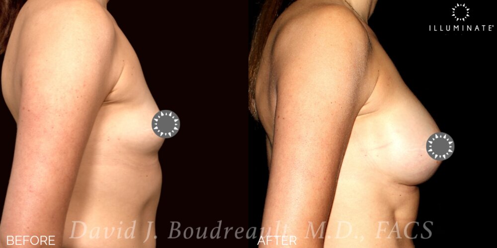 Breast Augmentation Before & After Image