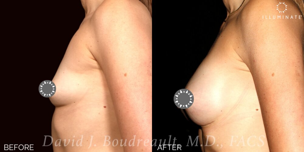 Breast Augmentation Before & After Image