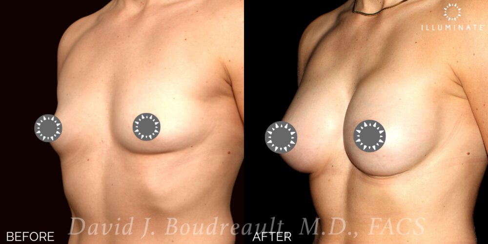 Breast Augmentation Before & After Image