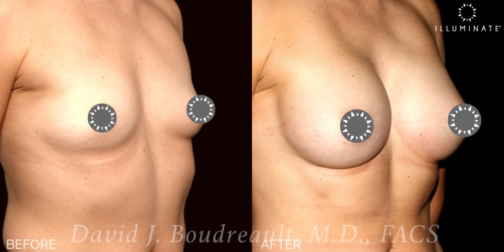 Breast Augmentation Before & After Image