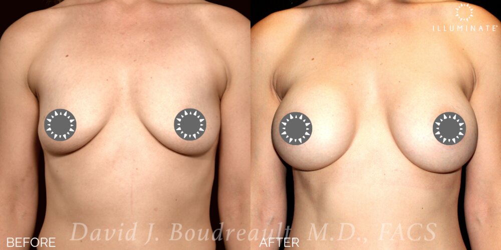 Breast Augmentation Before & After Image