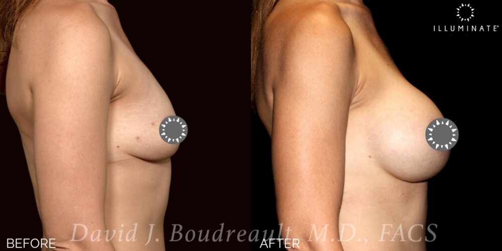 Breast Augmentation Before & After Image