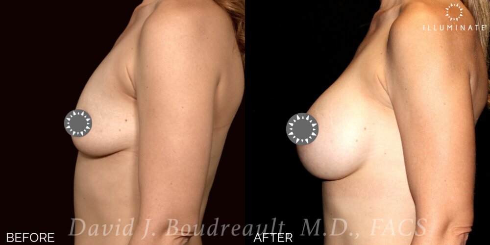 Breast Augmentation Before & After Image